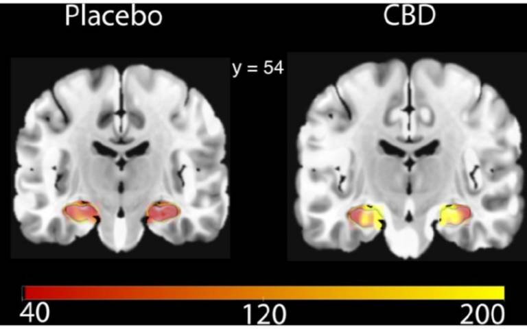 A shot of two brain scans showing difference in CBD and placebo effects